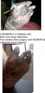 BUNION with CALLUS ,Best diabetic foot surgeon india ,  best diabetic foot doctor india ,  best diabetic foot surgeon in Hyderabad ,   best podiatrist in india ,  podiatrist in Hyderabad ,  best diabetic foot doctor Hyderabad,  diabetic foot clinic India,  diabetic foot clinic Hyderabad,  diabetes foot specialist,  