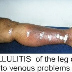Cellulitis Leg , LEG SWELLING , LEG PAIN , VARICOSE VEINS , leg pain at night , varicose ulcer , venous stasis dermatitis , leg ulcers , venous stasis ulcer , venous stasis , venous ulcer , cellulitis leg , stasis dermatitis , leg cramps at night , Varicose Veins Treatment , leg swelling , leg muscles , leg cramps , lower leg pain , cellulitis , varicose veins , eczema , skin ulcer , restless leg syndrome, leg pain , blood clot in leg ,