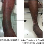 Cellulitis Leg , LEG SWELLING , LEG PAIN , VARICOSE VEINS