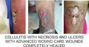 Cellulitis with Necrosis & Ulcers