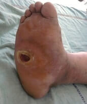 Diabetic Foot Charcot Ulcer
