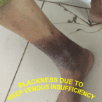 DEEP VENOUS INSUFFICIENCY with leg blackening , leg pain at night , varicose ulcer , venous stasis dermatitis , leg ulcers , venous stasis ulcer , venous stasis , venous ulcer , cellulitis leg , stasis dermatitis , leg cramps at night , Varicose Veins Treatment , leg swelling , leg muscles , leg cramps , lower leg pain , cellulitis , varicose veins , eczema , skin ulcer , VENOUS ULCER WITH DVI , BLOOD CLOT IN LEG