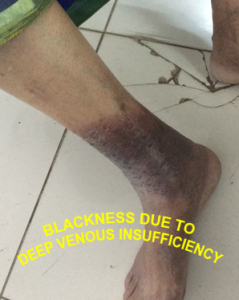 DEEP VENOUS INSUFFICIENCY with leg blackening , leg pain at night , varicose ulcer , venous stasis dermatitis , leg ulcers , venous stasis ulcer , venous stasis , venous ulcer , cellulitis leg , stasis dermatitis , leg cramps at night , Varicose Veins Treatment , leg swelling , leg muscles , leg cramps , lower leg pain , cellulitis , varicose veins , eczema , skin ulcer , VENOUS ULCER WITH DVI , BLOOD CLOT IN LEG