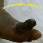 diabetic gangrene , DIABETIC FOOT CLINIC , diabetes foot care , foot ulcer, diabetic foot treatment , diabetic ulcer , diabetic footwear , gangrene treatment , diabetic foot care , charcot foot , diabetes care , diabetic foot ulcer ,