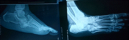 Charcot Foot X ray