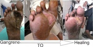 Diabetic Foot Gangrene