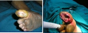 Diabetic Foot Infection