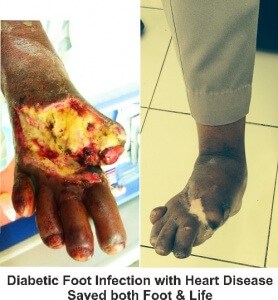 Diabetic Foot Infection with Heart Disease