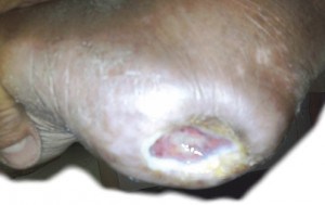 Diabetic Foot Ulcer