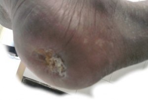 Diabetic Foot Ulcer Heel