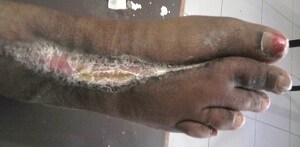 FOREFOOT GANGRENE DIABETIC FOOT ULCER 1