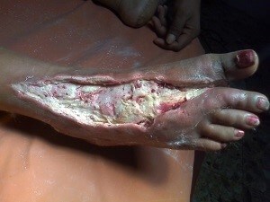 DIABETIC FOOT ULCER (CLINIC) , DIABETIC FOOT TREATMENT , DIABETIC ULCER , diabetes foot care , diabetes care , foot ulcer, DIABETIC FOOT CLINIC HYDERABAD , DIABETIC FOOT SURGEON HYDERABAD