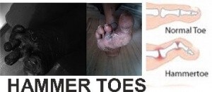 Diabetic Foot Hammer Toes