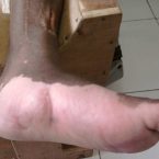 CHARCOT FOOT , DIABETIC FOOT ULCER , DIABETIC FOOT TREATMENT , GANGRENE , Wound care , wound healing , foot care , diabetes foot care , diabetes care , foot ulcer,