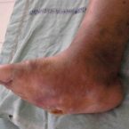 CHARCOT FOOT , DIABETIC FOOT ULCER , DIABETIC FOOT TREATMENT , GANGRENE , Wound care , wound healing , foot care , diabetes foot care , diabetes care , foot ulcer,