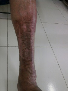 CELLULITIS