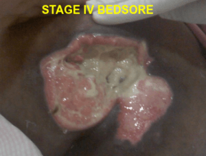 STAGE IV BEDSORE