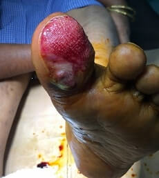 Diabetic Foot Infection