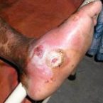 CHARCOT FOOT , DIABETIC FOOT ULCER , DIABETIC FOOT TREATMENT , GANGRENE , Wound care , wound healing , foot care , diabetes foot care , diabetes care , foot ulcer,