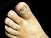 INGROWN TOE NAIL - Diabetic Foot Clinic