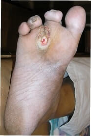 Cracked Callus in a Diabetic Foot