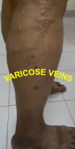 VARICOSE VEINS , venous stasis ulcer , venous stasis , venous ulcer , cellulitis leg , stasis dermatitis , leg cramps at night , Varicose Veins Treatment , leg swelling , leg muscles , leg cramps , lower leg pain , cellulitis , varicose veins , eczema , skin ulcer , restless leg syndrome, leg pain , blood clot in leg ,