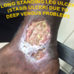 VENOUS ULCER DUE TO DVI , leg pain at night , varicose ulcer , venous stasis dermatitis , leg ulcers , venous stasis ulcer , venous stasis , venous ulcer , cellulitis leg , stasis dermatitis , leg cramps at night , Varicose Veins Treatment , leg swelling , leg muscles , leg cramps , lower leg pain , cellulitis , varicose veins , eczema , skin ulcer