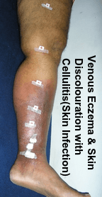 Venous Eczema