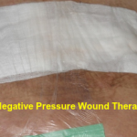 WOUNDS , Wound Therapy , Wound care , wound healing , negative pressure wound therapy , wound infection , Best diabetic foot surgeon india ,  best diabetic foot doctor india ,  best diabetic foot surgeon in Hyderabad ,   best podiatrist in india ,  podiatrist in Hyderabad ,  best diabetic foot doctor Hyderabad, 