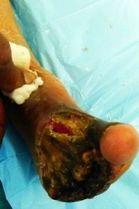 Gangrene , Wound care , diabetes care , wound healing , foot care , podiatrist , amputation , cellulitis , diabetic foot surgeon Hyderabad(india)