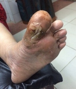 Diabetic toe ulcer