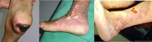 gangrene, eczema, diabetic foot