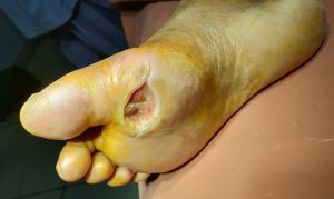 A commonly occurring diabetic foot ulcer, not very amenable to treatment