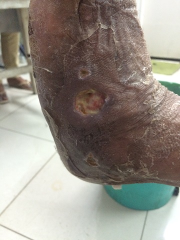 Charcot Foot With dorsum infection