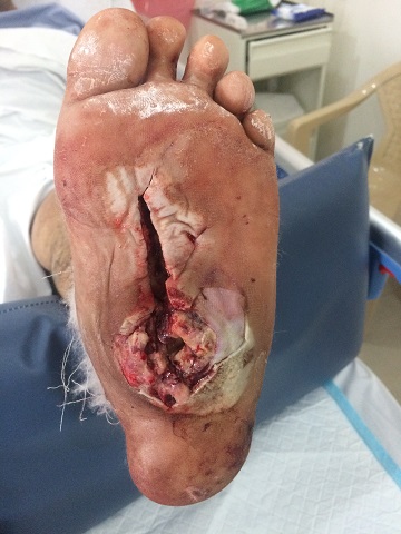 Charcot Foot with Plantar Abscess